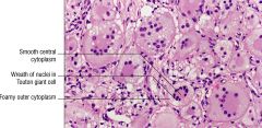 Juvenile xanthogranuloma
monotonous CD68+ histiocytic cells
