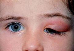 inflammation of lacrimal gland

complication of mumps
