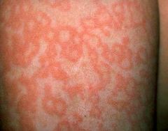 parvovirus B19 (DNA)

--arthritis
--slapped cheek
--lacy, reticulated rash over trunk and extremities (no palms/soles!!)

rash = up to 40d