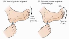 Stroking of the lateral foot and across the plantar base of the toes. Normally, the toes should flex and curl inward. Abnormally, the Babinski sign is the extension and fanning of the toes in response to the plantar stimulus. This is due to a UMN lesion i