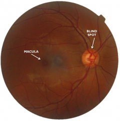 Fundus of right eye: blind spot is also nasal to macula.