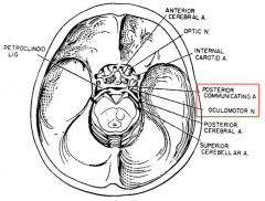 Compression of the oculomotor nerve. Pupil will be dilated because the parasympathetic tone is affected. Parasympathetic fibers ride superficially on the oculomotor nerve bundle; therefore compression causes PNS Sx first.