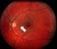 A unilateral retinal lesion at this location will result in what visual field deficit?