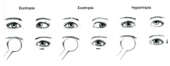 Evaluation of tropia. Cover the fixating eye, observe the response of the non-fixating eye.