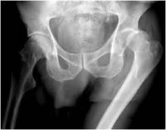 Posterior dislocation is more common.
Typically shortening, adduction and internal rotation of the extremity is seen.