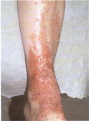 Dermatitis of the lower leg from PVD
-MC prox to med mall
+/- ulcer
-a/w brown hemosiderin hyperpigmentation