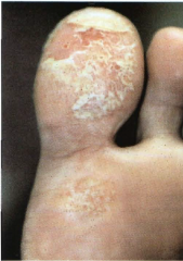 Vesicular hand and foot eczema w/ pruritis
-MC sides of fingers and soles of feet
-deep seated small vesicles - tapioca appearance
-sweating plays no role in pathogenesis
