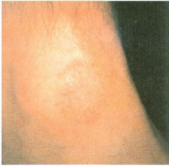 Coin shaped plaques
-small papules/vesicles on a eryth base
-MC in lower legs of older men
-a/w bacterial infection
Tx: dicloxacillin or erythromycin