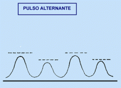 Pulso altera de amplitude de um batimento para o outro, mas o ritmo é regular - Insuficiência ventricular E, com B3