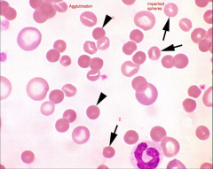 Identify the cells/structures & what is your diagnosis?
1.
2.
Dx: