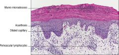 psoriasis vulgaris
Parakeratosis
Neutrophils in parakeratotic layer (Munro's microabscesses)
Loss of granular layer