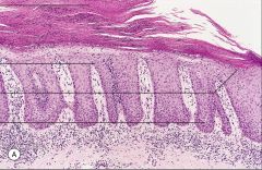 Describe 3 histologic features of the lesion shown.