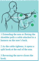 - Operates prosthesis - upper body movements create tension on cable, operating prosthesis
- Functions by interacting w/ harness and stainless steel cable