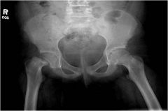 A disorder in adolescents in which a fracture of the growth plate results in separation of the ball of the hip joint from the femur.
- More common in males
- Causes painful limp and limited hip internal rotation and abduction
- Change in ROM is...