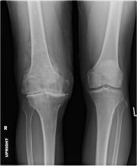 What diagnosis would you make based on this x-ray?