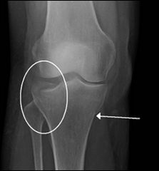 Can occur on plateau, shaft or malleolus.