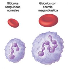 ¿Que es la Anemia Megaloblástica?