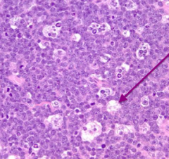 This biopsy shows the "starry night" pattern which indicates the Follicular Lymphoma transformed into Burkitt Lymphoma

- c-MYC - characteristic of Burkitt lymphoma, t(8;14)
- BCL-2 - over-expressed in original Follicular lymphoma