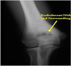 Tumor of unknown etiology that is composed of osteoid and woven bone, usually smaller than 1.5 cm diameter. Can occur in any bone, but in 2/3 of patients, the appendicular skeleton is involved.

Classic presentation
- Focal bone pain at site of...