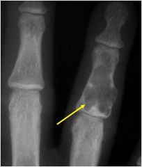 Intramedullary cartilaginous cysts commonly found in the small bones of the hands and feet. Grow in childhood and remain present in adulthood, often found in patients 10-20 years old.
On x-ray, appears as small (less than 5 cm) lobe-shaped or ova...