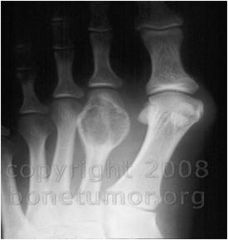 Lesions are located on the surface of bone, metaphysis and epiphysis and usually occurs in 20-30s. X-rays show striking expansile lesion with internal septae or longitudinal striations. If highly expansile and at end of bone, it may be referred as...