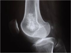 Slower growing than osteosarcomas and tumor produces cartilaginous matrix.
Metaphysis is most common location in long bones.
More common in people over 60.
Presents with pain and swelling in a bone.
Fusiform, lucent defect with scalloping of t...