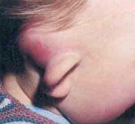 Bilde av en mastoiditt, alvorlig komplikasjon av otitis media akuta. Hvordan bør dette behandles?