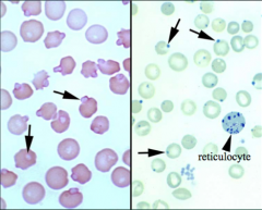 Identify the cells/structures pointed by the arrows, what stain was used to confirm their presence & what are their clinical significance?
Arrow:
Stain:
Significance: