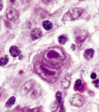 Reed Sternberg cells
- Large
- Frequent binucleation
- Large, eosinophilic nucleoli ("owl eyes")