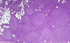Follicular Lymphoma (or could be Hyperplasia)