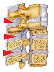Sheets of ligament that run between the spinous processes of vertebra
