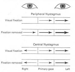 1. They drift towards the affected side (which is "pushing" less.

2. It increases when looking towards the unaffected ear. 

image 86 (arrows point towards the fast phase, arrow thickness represents the intensity of the nystagmus).