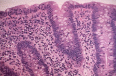 Gross: Normal
Micro: transmucosal lymphocytic infiltrate & inflammatory cells in surface epithelium
