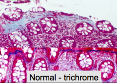 Gross: Normal
Micro: transmucosal lymphocytic infiltrate & inflammatory cells in surface epithelium w/ ***thick sub epithelial collagen band***