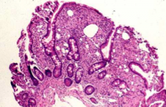 etiology: gram + actinomycete

histologic: blunting of villi & foamy macrophages