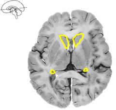 What is the yellow structure around the lateral ventricles?