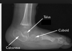 what congenital foot deformity is shown on this lateral radiograph? (google images)