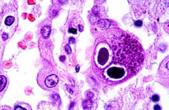 Colonoscopy & biopsy:
- giant cells w/ cytomegaly & large nuclei containing basophilic inclusions (owl's eyes, halo rim)