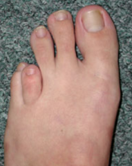 12yo F presents for evaluation of 'short toes'. Clinical picture is consistent with?