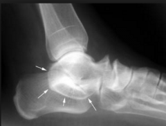 13yo F presents with left lateral submalleolar pain during long periods of walking. Patient has bilateral residual clubfeet and underwent a posterior medial release at 11 months of age. X-rays indicate? (google images)