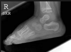 What foot deformity is consistent with these DP and lateral radiographs? (google images)