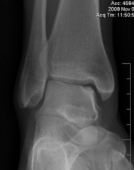 17yo F presents with aching pain over the dorsal ankle. pain occurs 5-6 miles into the run. pain began 4 months earlier. she runs 12-15 miles a week. No Hx of trauma. Radiograph indicates?