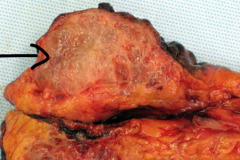 Benign pancreatic lesion w/ central scar, commonly seen in women in the 7th decade of life: