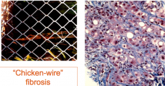 "chicken-wire" fibrosis aka peri-cellular