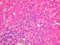 inflammatory infiltrate spilling over into parenchyma from the portal tracts. notice the presence of plasma cells

seen in Hep C & AIH