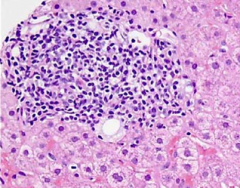 - bile duct is obscured by inflammatory cells
- can also have granuloma formation