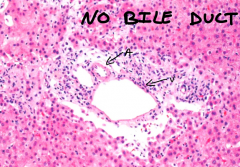 the absence of a bile duct