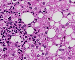 NASH: lymphocytic (pictured)

alcoholic: neutrophilic