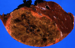 solitary tumor, 10-30cm, adjacent liver is NONCIRRHOTIC

may cause severe hemorrhage