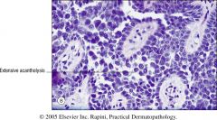 Hailey-Hailey disease (Benign familial pemphigus)
AD, deficiency of desmoplakin and plakoglobin
"dilapidated brick wall"
DIF is negative